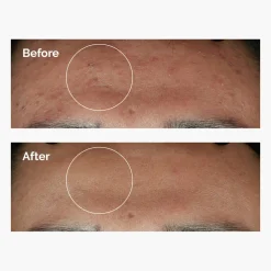 The Ordinary Niacinamide 10% + Zinc 1%